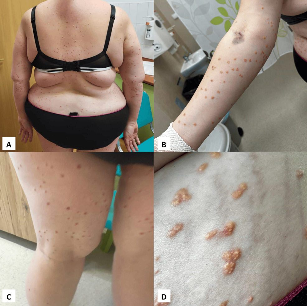 Identifying Xanthelasma: A Visual Reference, image size:986x981