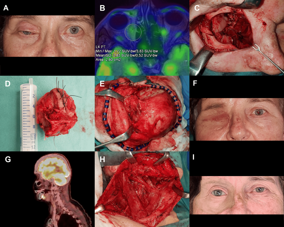 En Bloc Orbitectomy in the Management of Advanced Orbital Cancer: A Retrospective Study of Seven Different Carcinomas