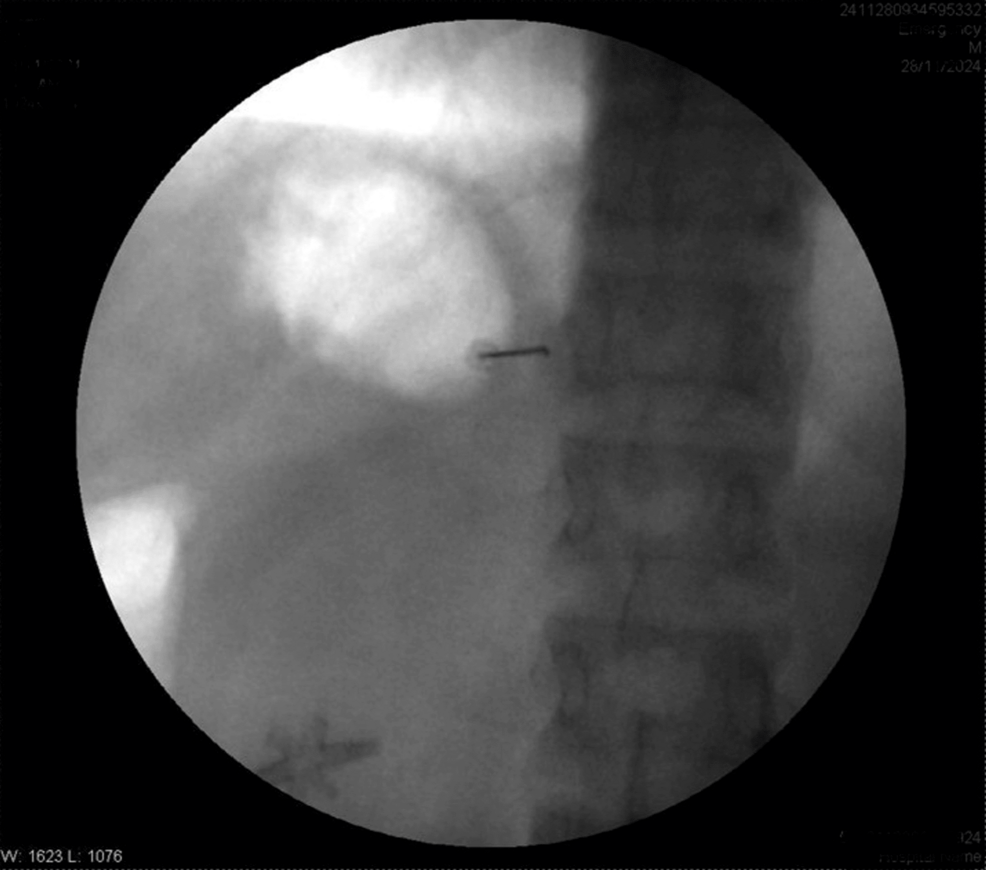 Needle-at-T12-transverse process Needle-at-T12-transverse process