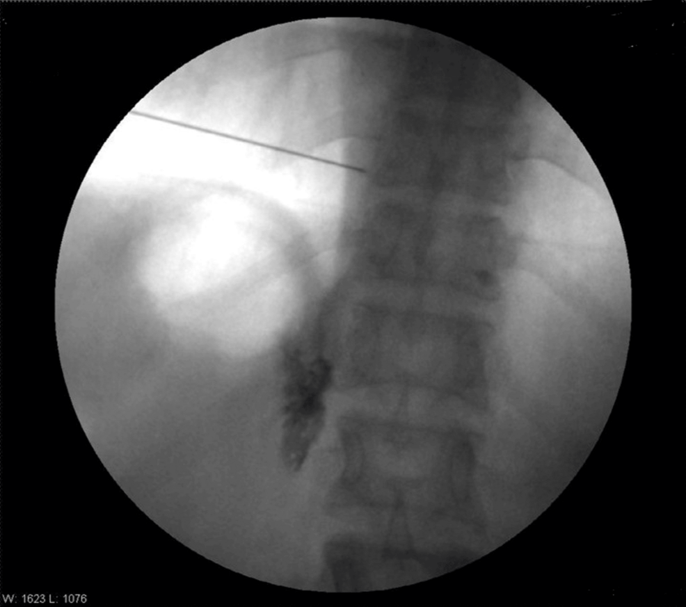 Anterior-posterior-fluoroscopic-view-after-radio-contrast-dye-iohexol 300 injection Anterior-posterior-fluoroscopic-view-after-radio-contrast-dye-iohexol 300 injection