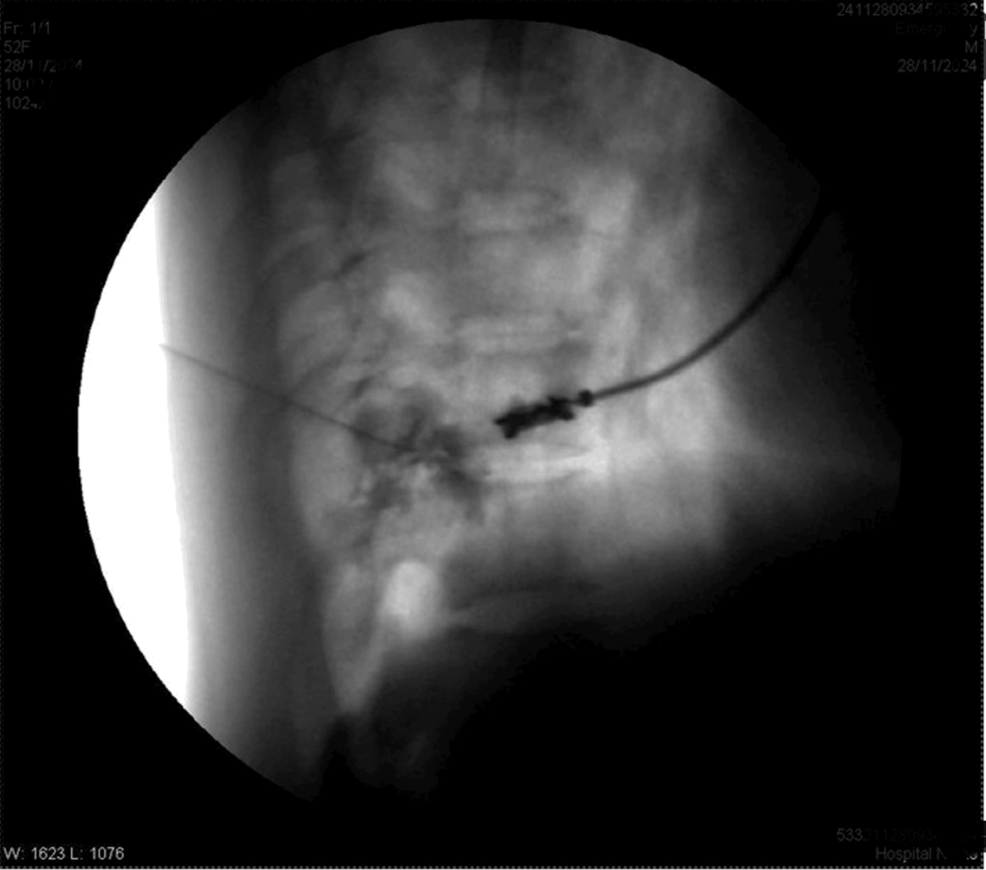 Lateral-fluoroscopic-view-after-radio-contrast dye Lateral-fluoroscopic-view-after-radio-contrast dye