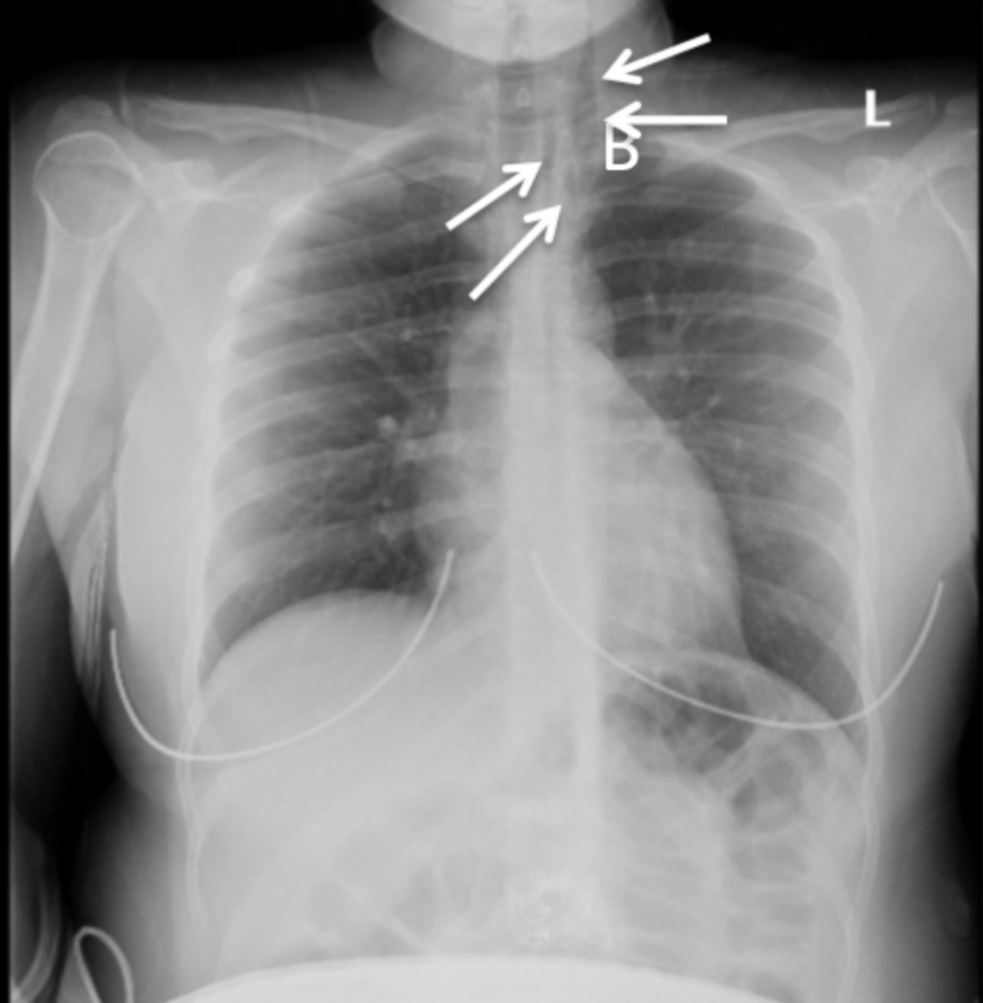 Cureus | A Rare Presentation of Asymptomatic Spontaneous Pneumomediastinum