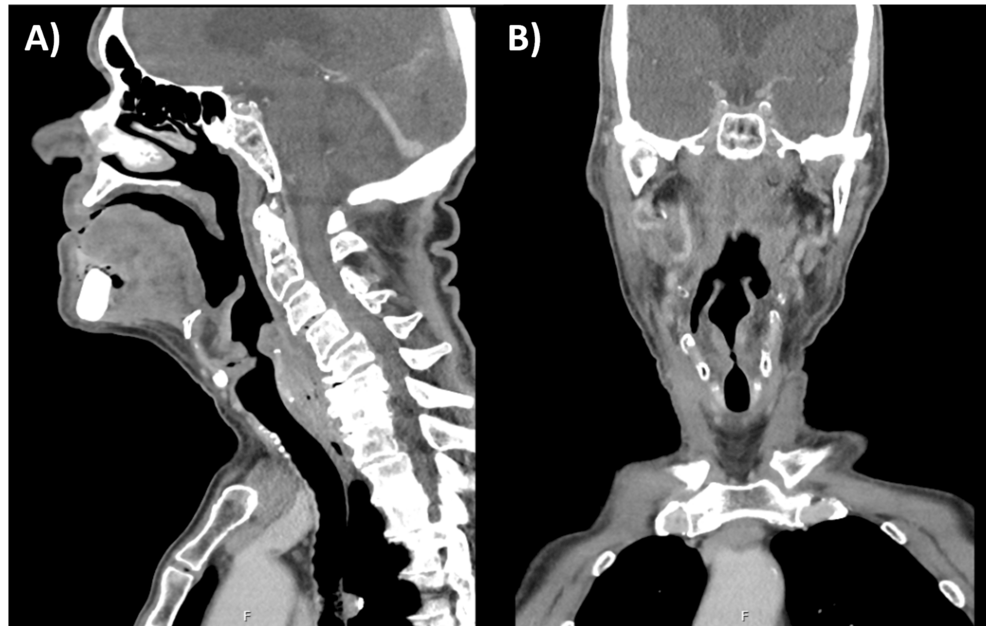 Takotsubo Cardiomyopathy Associated With the Usage of Nebulised Adrenaline for Acute Stridor: A Case Report