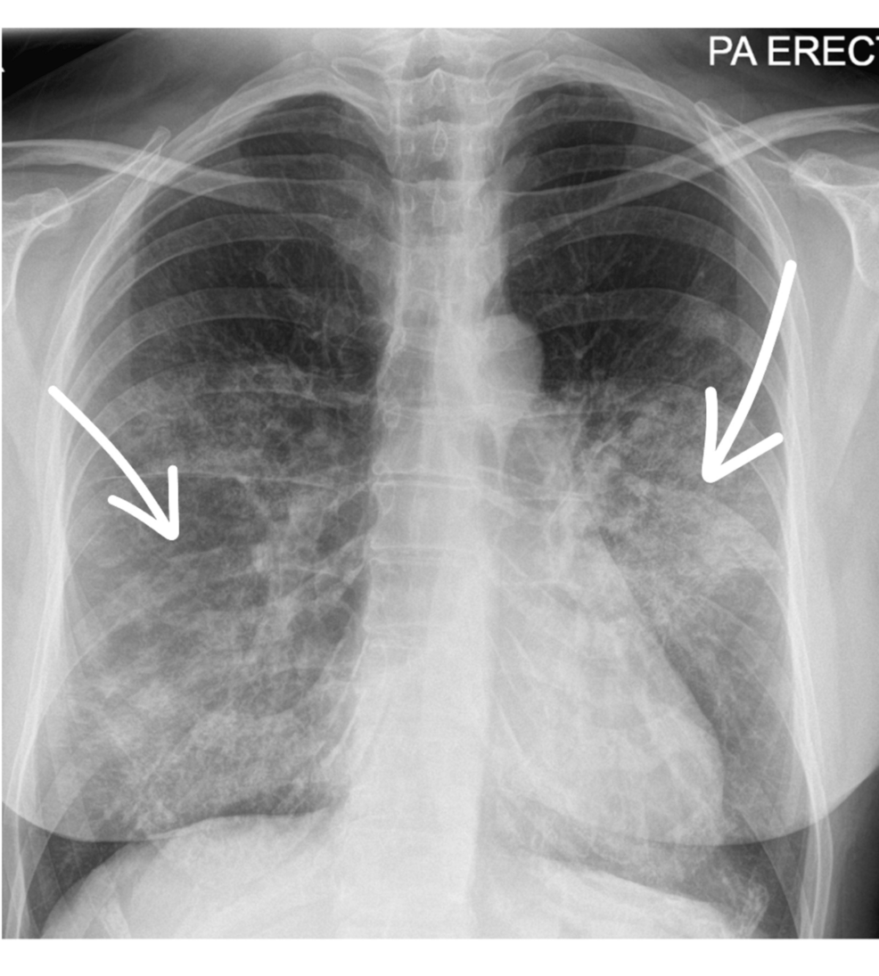 vape to vape pavilly Pneumothorax main image 0