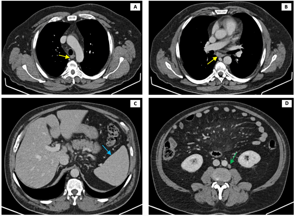 Familial Mediterranean Fever Intertwined With a Diagnosis of Crohn's Disease: A Case Report