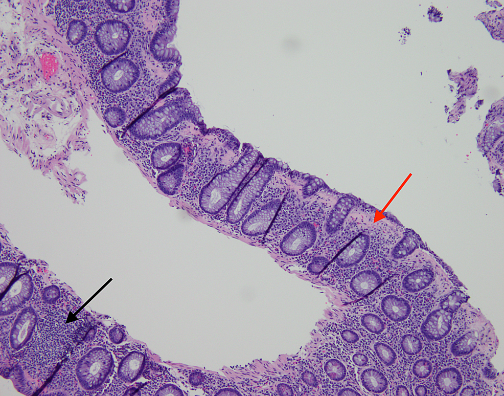 cureus-cannabidiol-oil-associated-microscopic-colitis