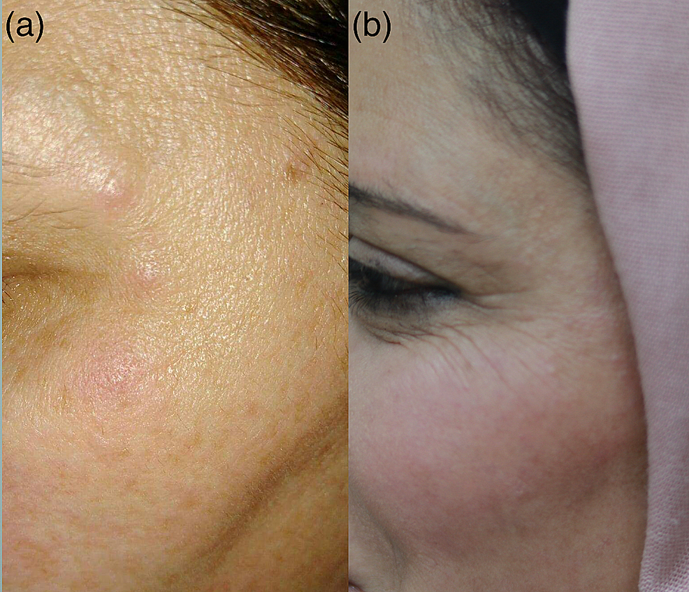 glutathione injections westchester ny Glutathione Shot - Bronx, NY