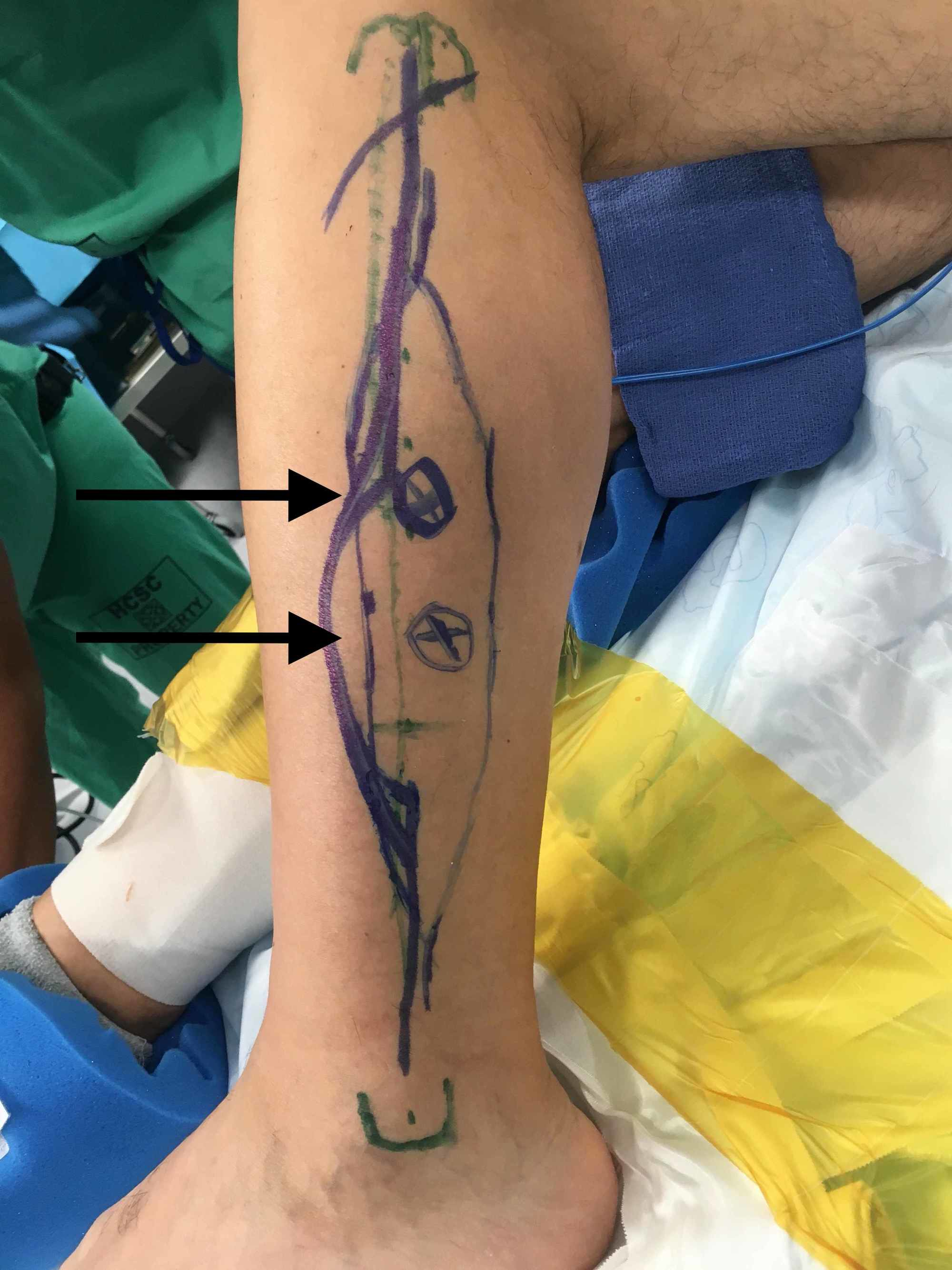 Cureus | Chimeric Free Fibula Flap: An Encounter With Aberrant Anatomy