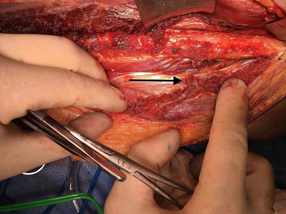 Mid-dissection-myocutaneous-perforator-identification-(arrow)
