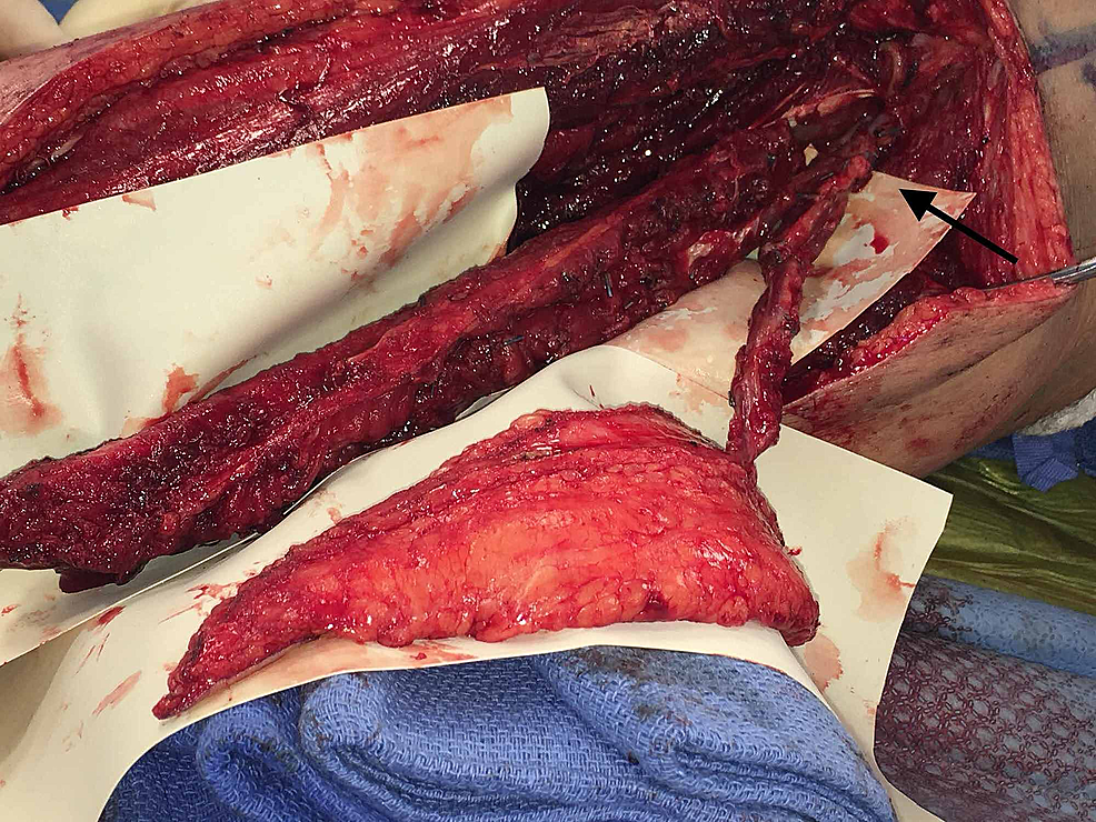 Dissected-chimeric-fibula-flap-with-short-common-peroneal-artery-pedicle-(arrow)