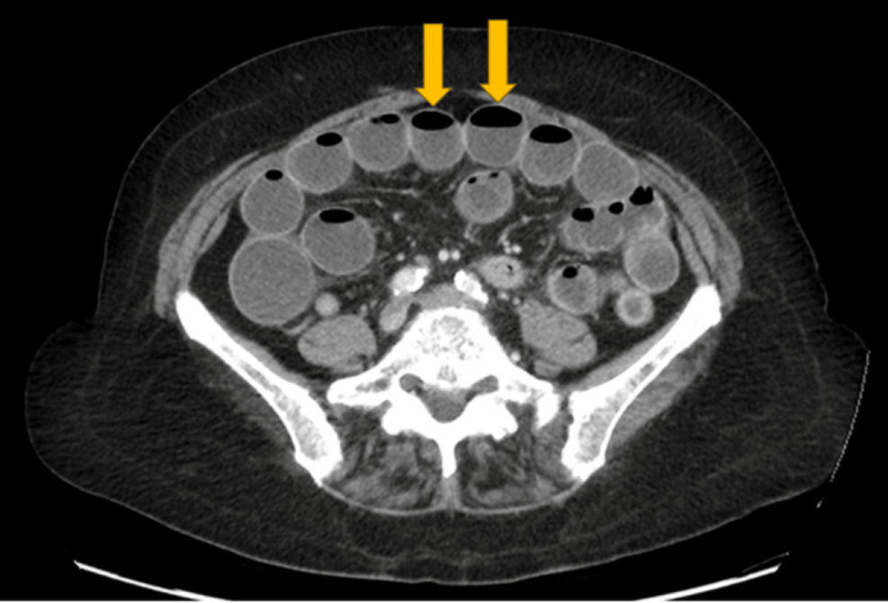 louisiana glp-1 gi obstruction class action GLP-1 Receptor Agonists in Diabetes and Obesity: A Case Report and Review  of Bowel Obstruction Risks and Management