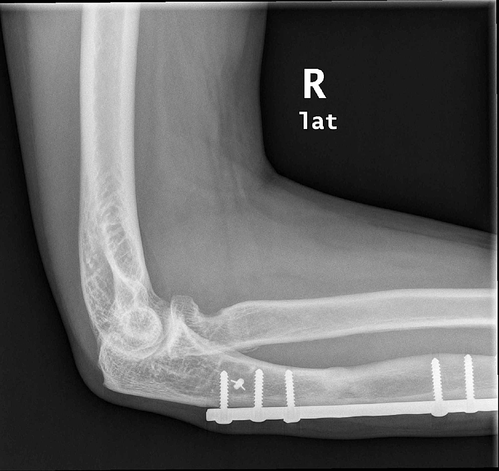 Cureus | Two-Year Outcome of Synthetic Annular Ligament Reconstruction ...