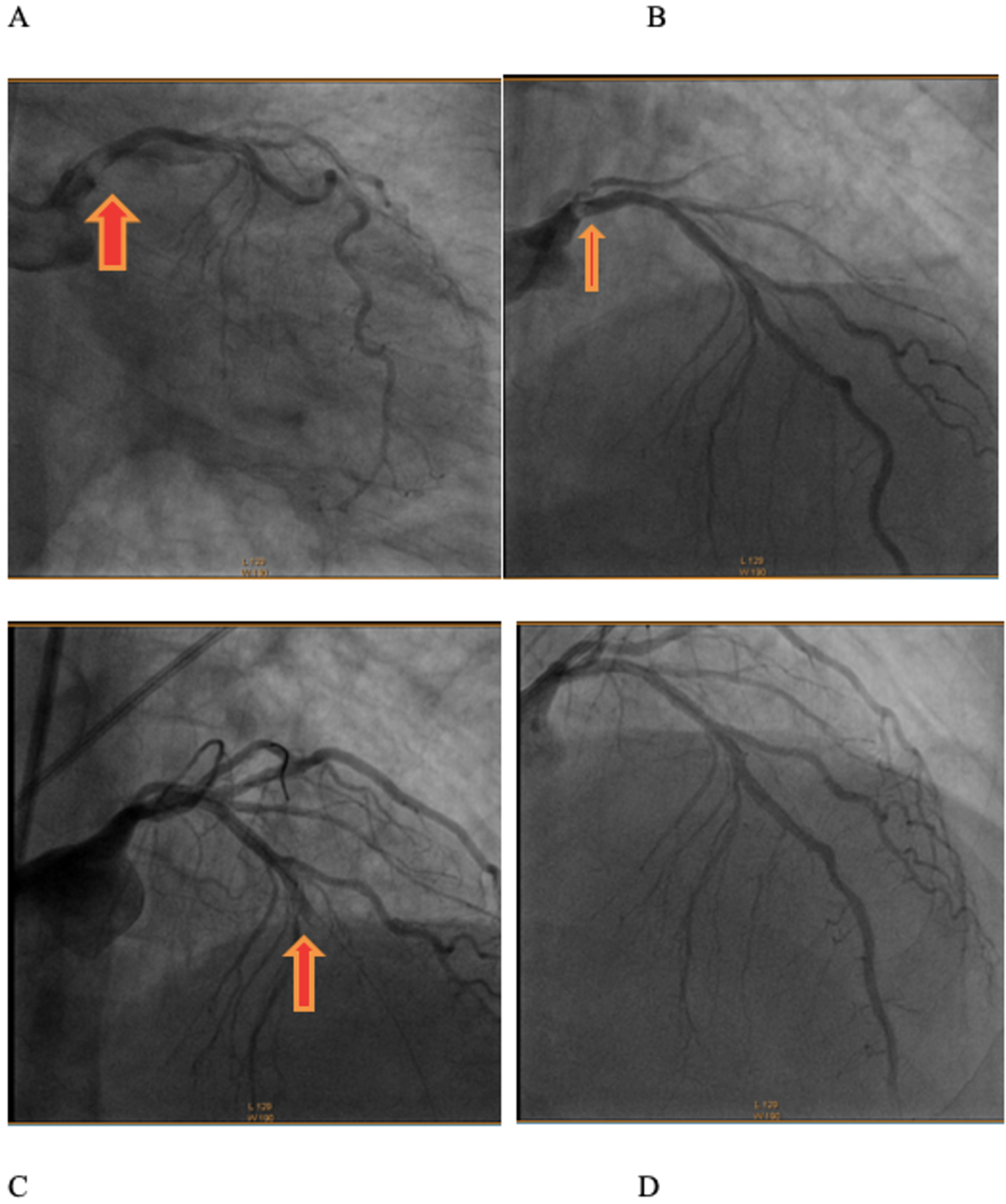 Cureus | A Ghost in Coronary Artery – Coronary Artery Embolism After Discontinuation of ...