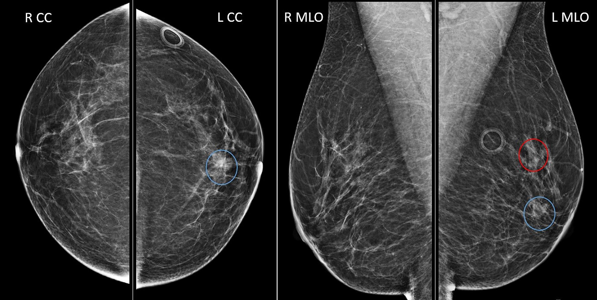 Cureus Successful Lumpectomy In A Patient With Multicentric Breast Cancer