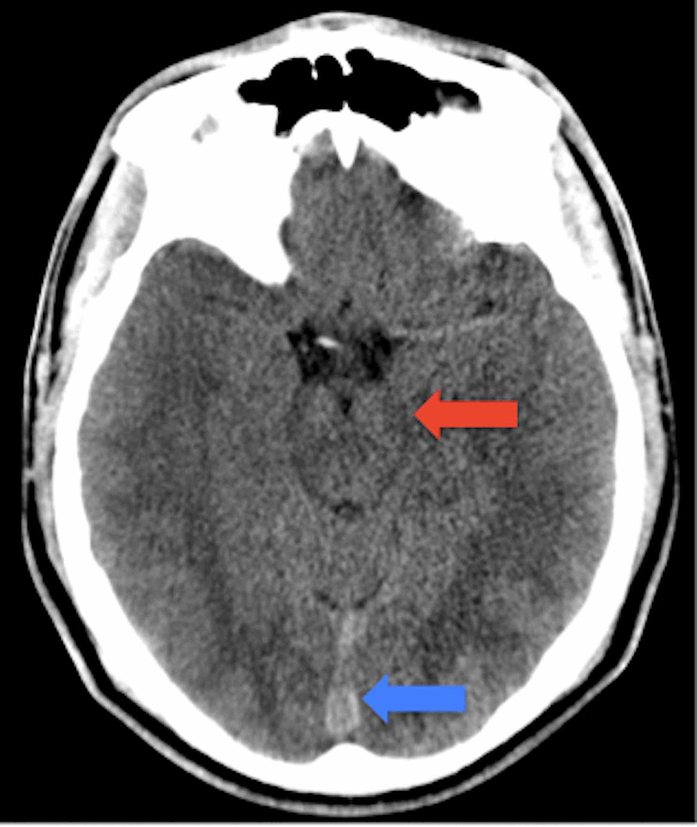 Cureus Intracranial Hypotension in the Setting of PostConcussion