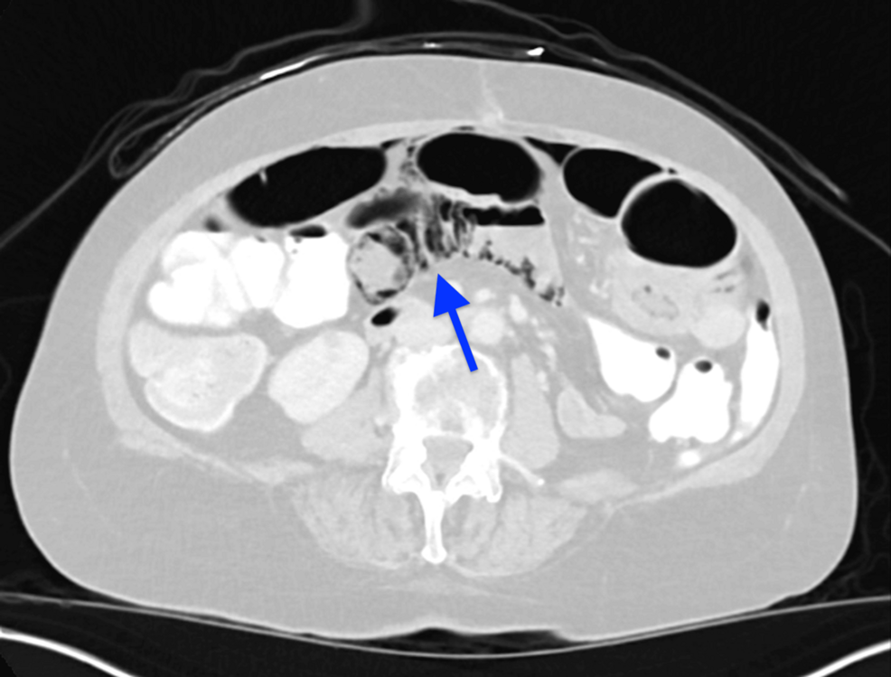 Representative-image-from-the-CT-scan-of-the-abdomen-showing-extensive-small-bowel-pneumatosis-(blue-arrow) Representative-image-from-the-CT-scan-of-the-abdomen-showing-extensive-small-bowel-pneumatosis-(blue-arrow)