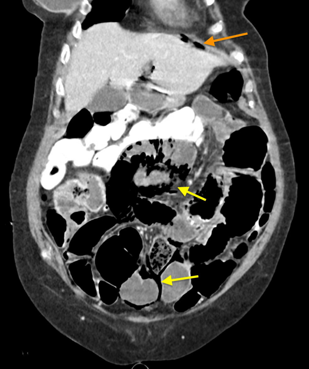 Small-volume-pneumoperitoneum-(orange-arrow)-noted-with-extensive-pneumatosis-intestinalis-(yellow-arrows).-Enteric-contrast-from-three-days-prior-for-assessment-of-constipation-noted-in-the-colon Small-volume-pneumoperitoneum-(orange-arrow)-noted-with-extensive-pneumatosis-intestinalis-(yellow-arrows).-Enteric-contrast-from-three-days-prior-for-assessment-of-constipation-noted-in-the-colon
