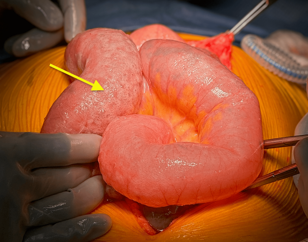 Intraoperative-photograph-of-the-diffuse-pneumatosis-of-otherwise-healthy-jejunum-(yellow-arrow) Intraoperative-photograph-of-the-diffuse-pneumatosis-of-otherwise-healthy-jejunum-(yellow-arrow)