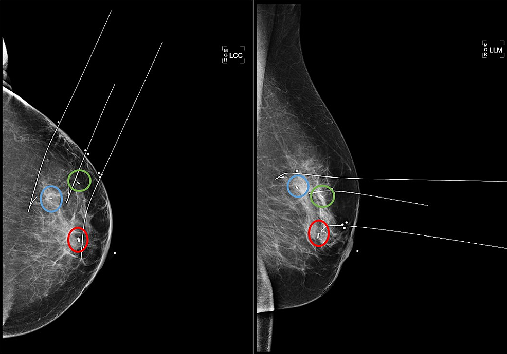 Cureus Successful Lumpectomy In A Patient With Multicentric Breast Cancer