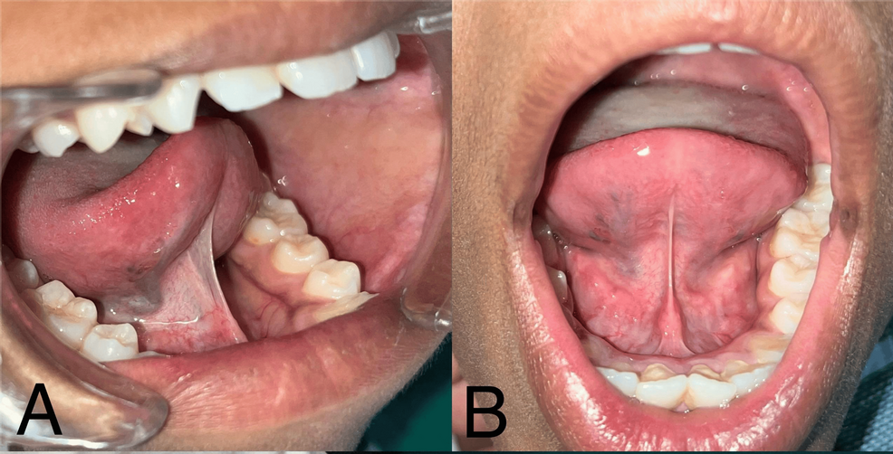 Postoperative Hematoma After Lingual Frenectomy: A Case Report