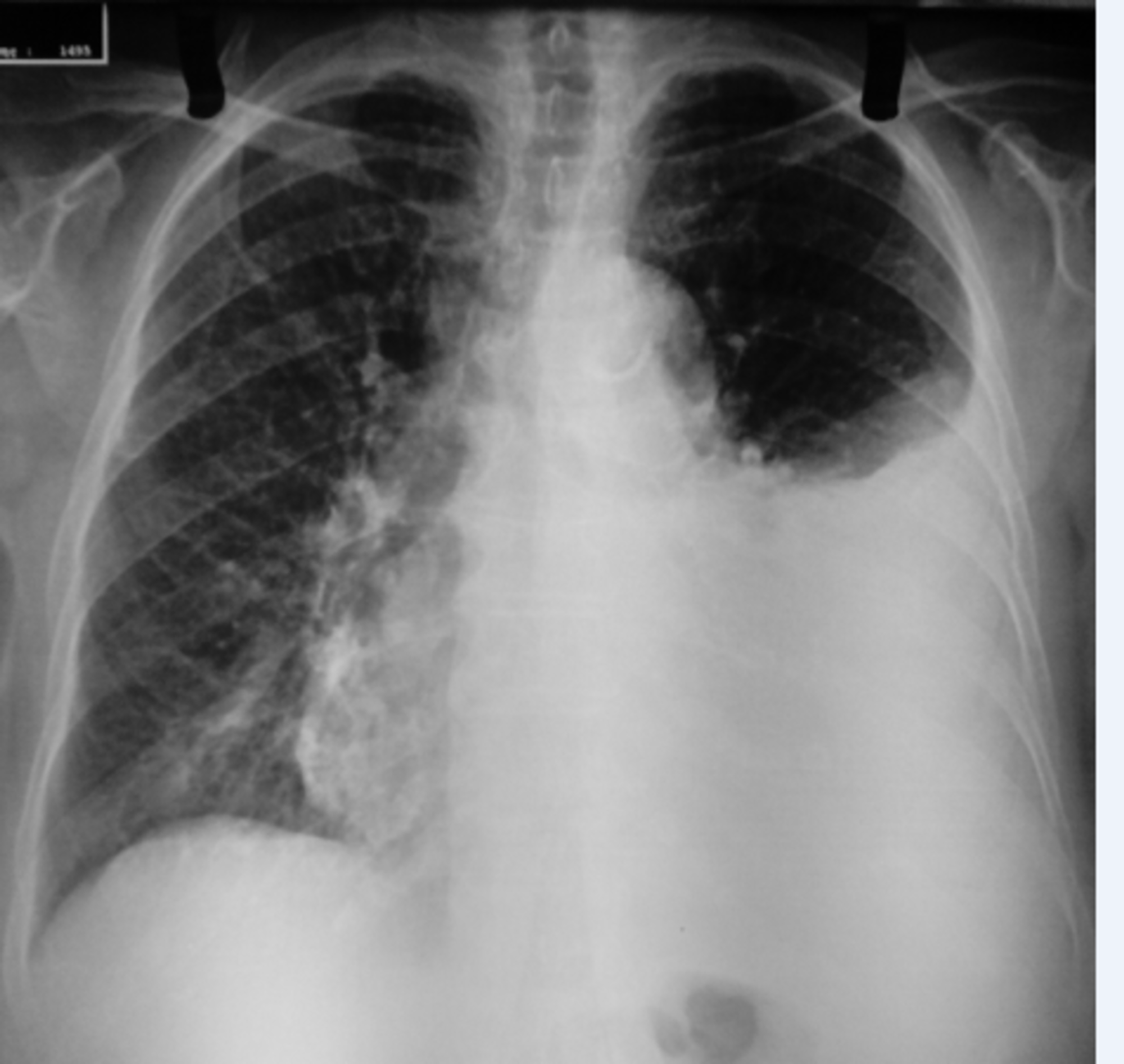 Cureus | Simultaneous Pleural and Pericardial Effusion as First ...