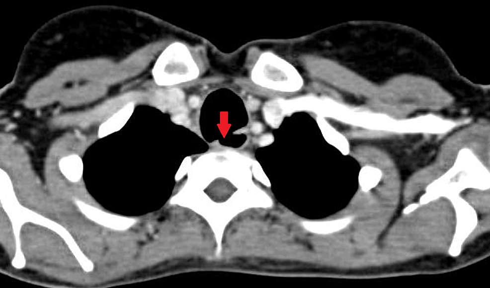 Stapled Repair of Benign Acquired Tracheoesophageal Fistula