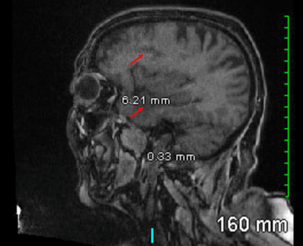 Glioblastoma Masquerading as Metastasis in a Routine Follow