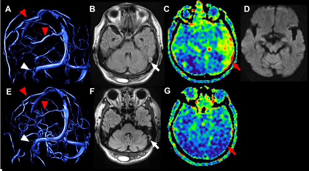 Recovering Language Function After Cerebral Venous Sinus Thrombosis: Tractography Insights into Sensory Aphasia Recovery Process