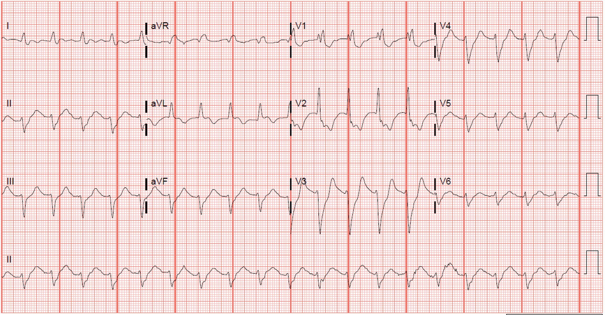 Cureus | An Unpleasant Surprise: Left Ventricular Pseudoaneurysm ...