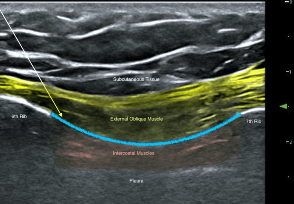 An-ultrasound-image-of-the-EOI-block