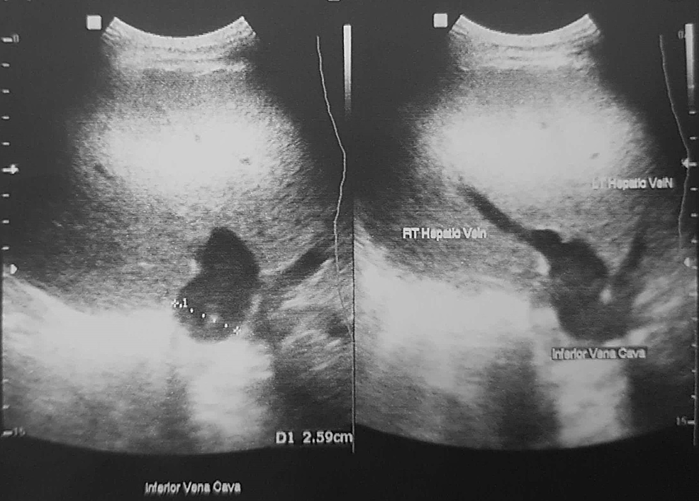 cureus-idiopathic-dilatation-of-inferior-vena-cava-a-case-report