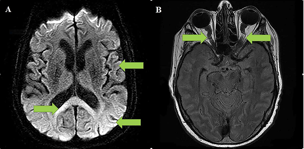 1A-demonstrates-severe-diffusion-restriction-in-the-brain's-subcortical-regions-and-the-splenium;-1B-demonstrates-the-tortuous-optic-nerve-sheath-secondary-to-intracranial-hypertension