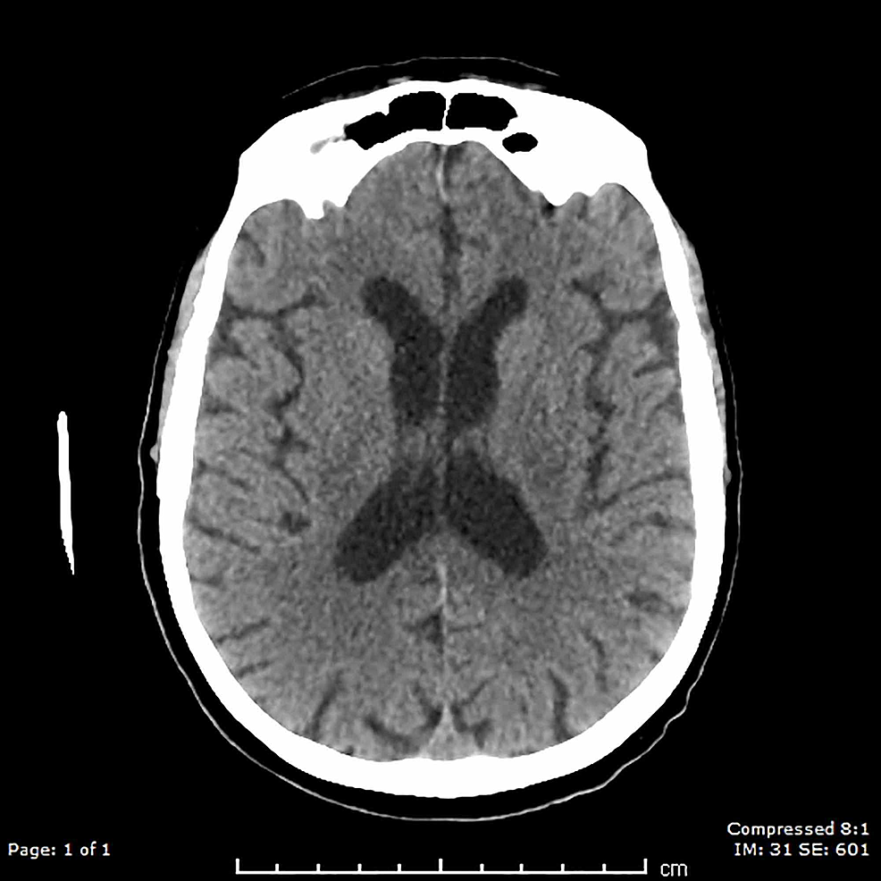 CT-brain-demonstrating-normal-findings-
