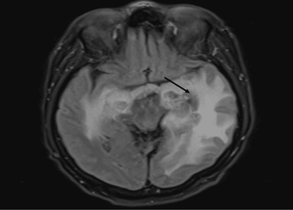 Cancer du rein métastasé au cerveau : thérapie cétogène