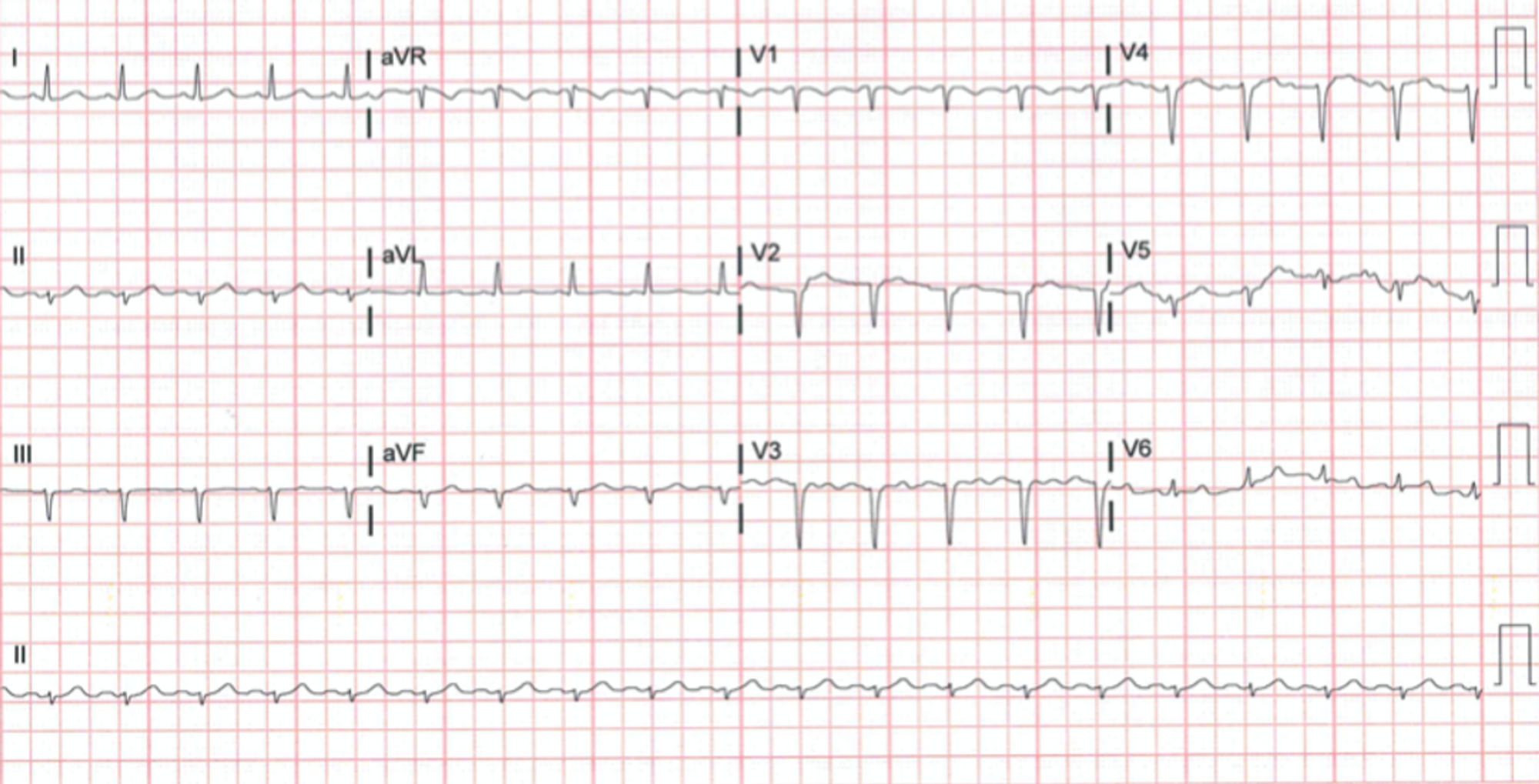 Cureus | COVID-19 Associated Coagulopathy in the Setting of Underlying ...