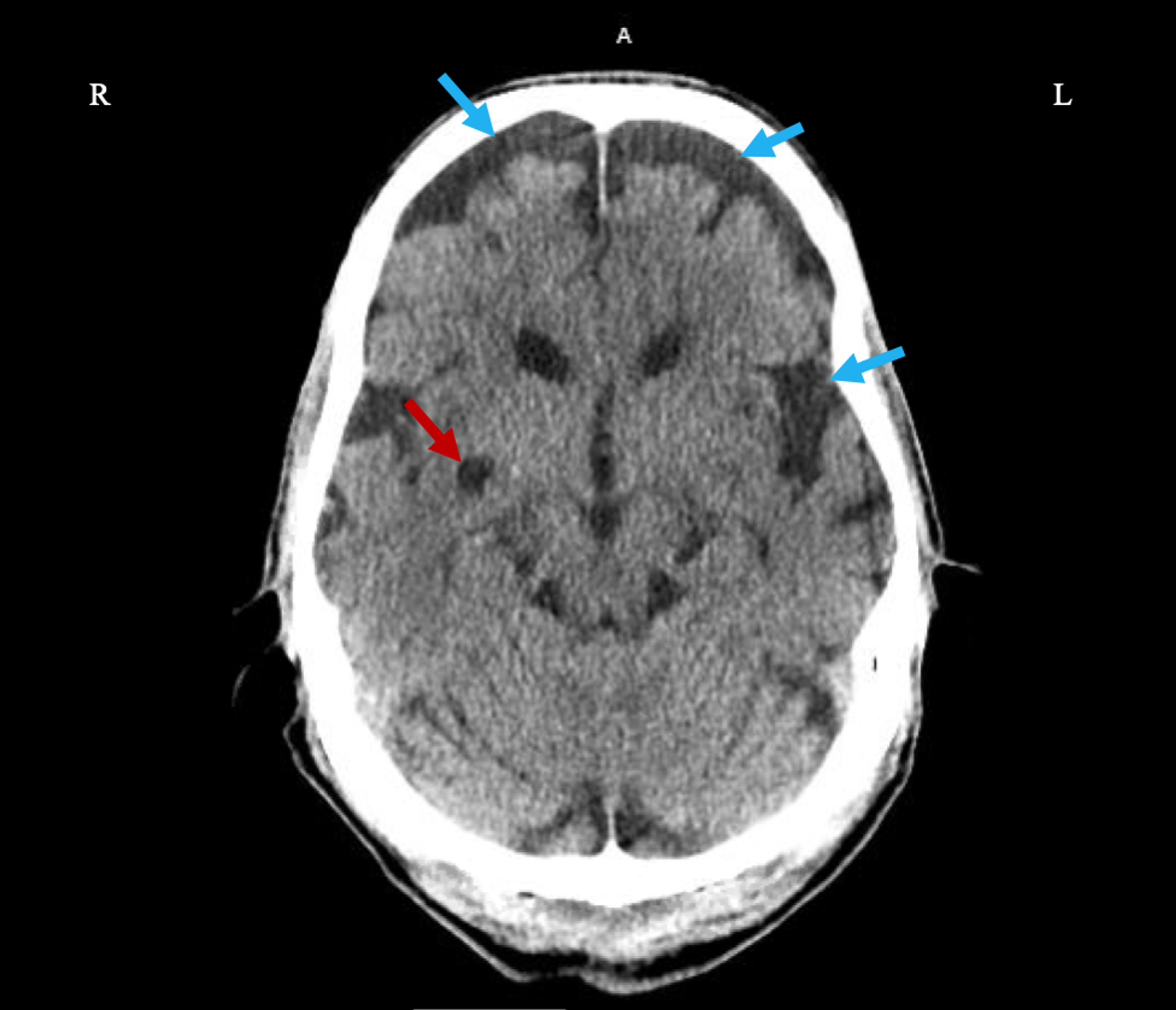 Cureus A Rare Case of CreutzfeldtJakob Disease in an 80YearOld Male