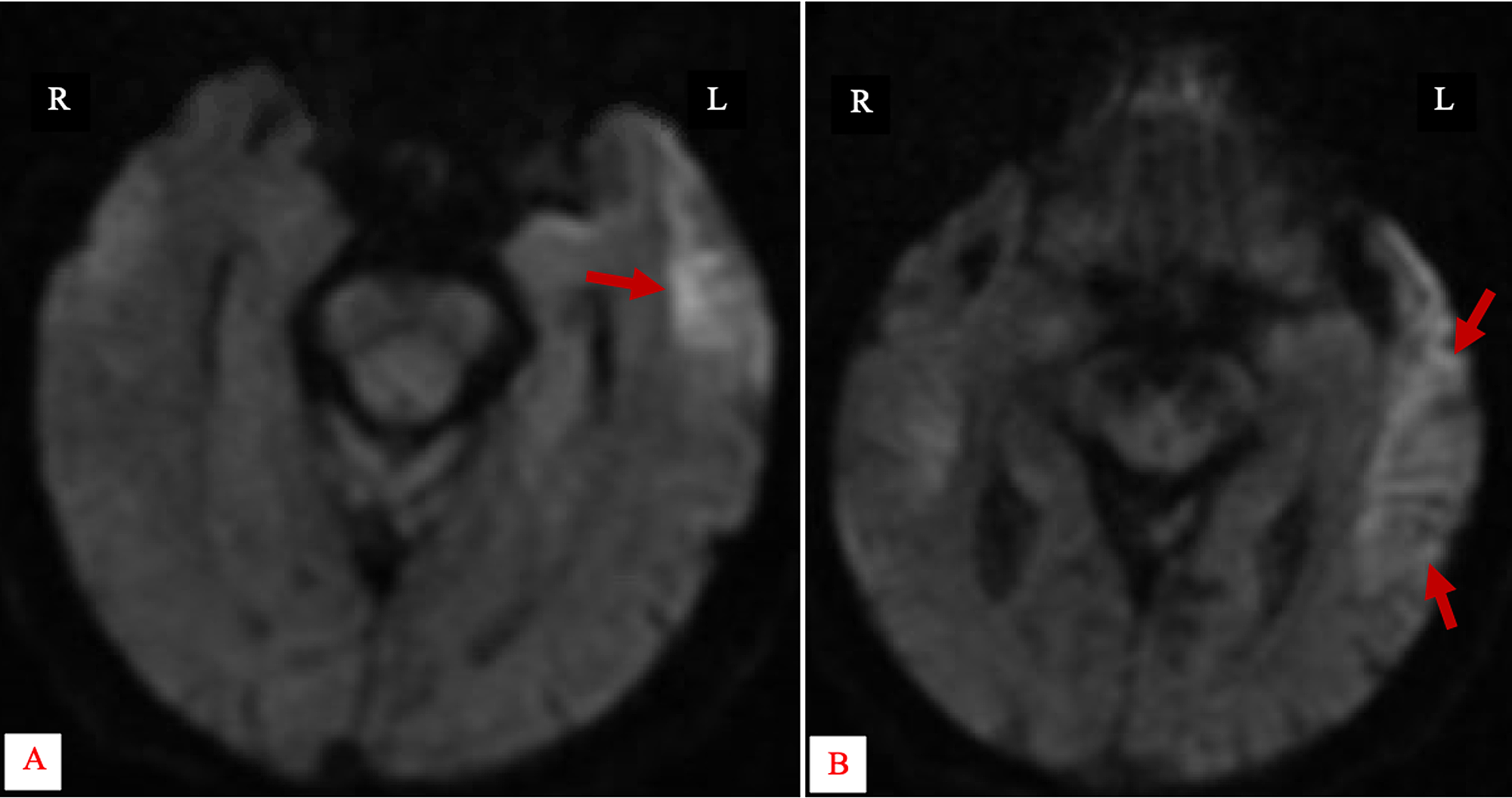 Cureus | A Rare Case Of Creutzfeldt-Jakob Disease In An 80-Year-Old Male