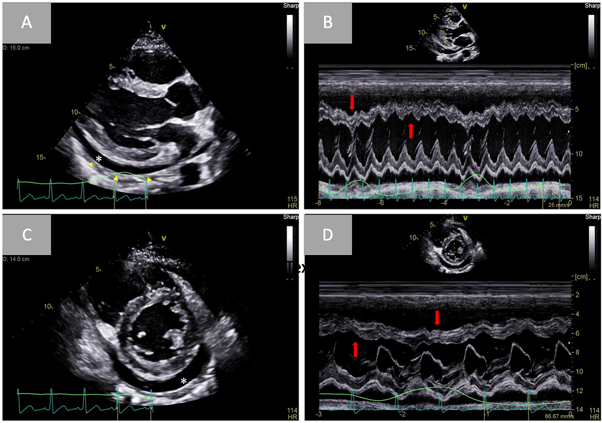 Cureus | Effusive-Constrictive Pericarditis in a Young Active Duty Male