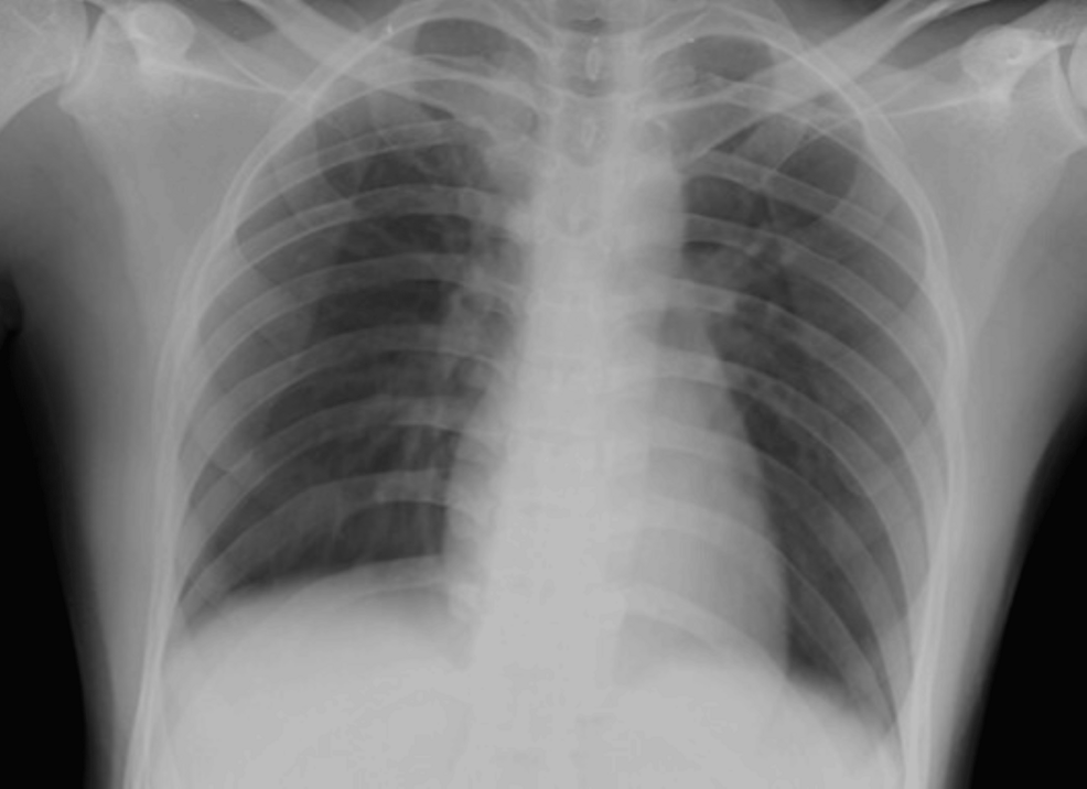 The-supine-chest-radiograph-(anteroposterior-(AP)-view)-of-a-23-year-old-female-patient-showed-no-obvious-radiopacities-in-both-lung-fields.-Radiographic-disease-score-was-0.