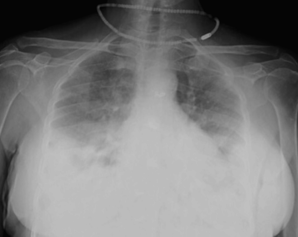 The-supine-chest-radiograph-(anteroposterior-(AP)-view)-of-a-64-year-old-female-patient-revealed-multiple-confluent-fluffy-radiopacities-in-the-bilateral-lower-lung-zones,-with-peripheral-predominance.-Ill-defined-ground-glass-opacities-were-seen-in-the-medial-parts-of-bilateral-lower-lung-zones-and-bilateral-mid-zones.-Radiographic-disease-score=4-(moderate-grade)-as-involvement-was-noted-in-both-sides-was-25%-to-50%.