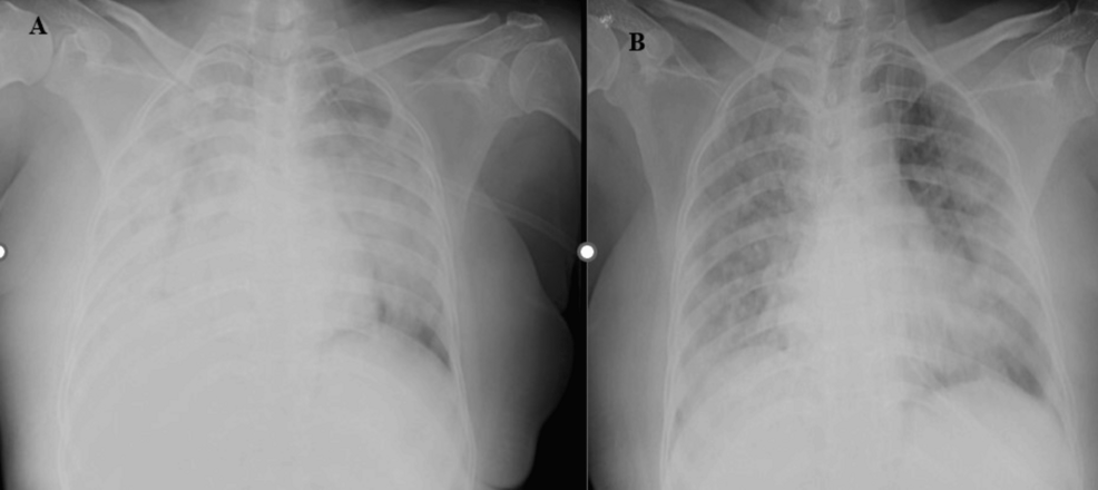 Figure-3A:-The-supine-chest-radiographs-(anteroposterior-(AP)-view)-of-a-53-year-old-male-patient-revealed-diffuse-ill-defined-heterogenous-opacities-with-few-linear-lucencies-likely-air-bronchogram-suggestive-of-consolidations-in-bilateral-lung-parenchyma-involving->-75%.-Radiographic-disease-severity-score-was-eight-(severe-grade).-Figure-3B:-Follow-up-AP-supine-chest-radiographs-of-the-same-patient-after-seven-days-revealed-areas-of-consolidations-and-ill-defined-nodules-in-bilateral-lung-parenchyma-involving->-75%.