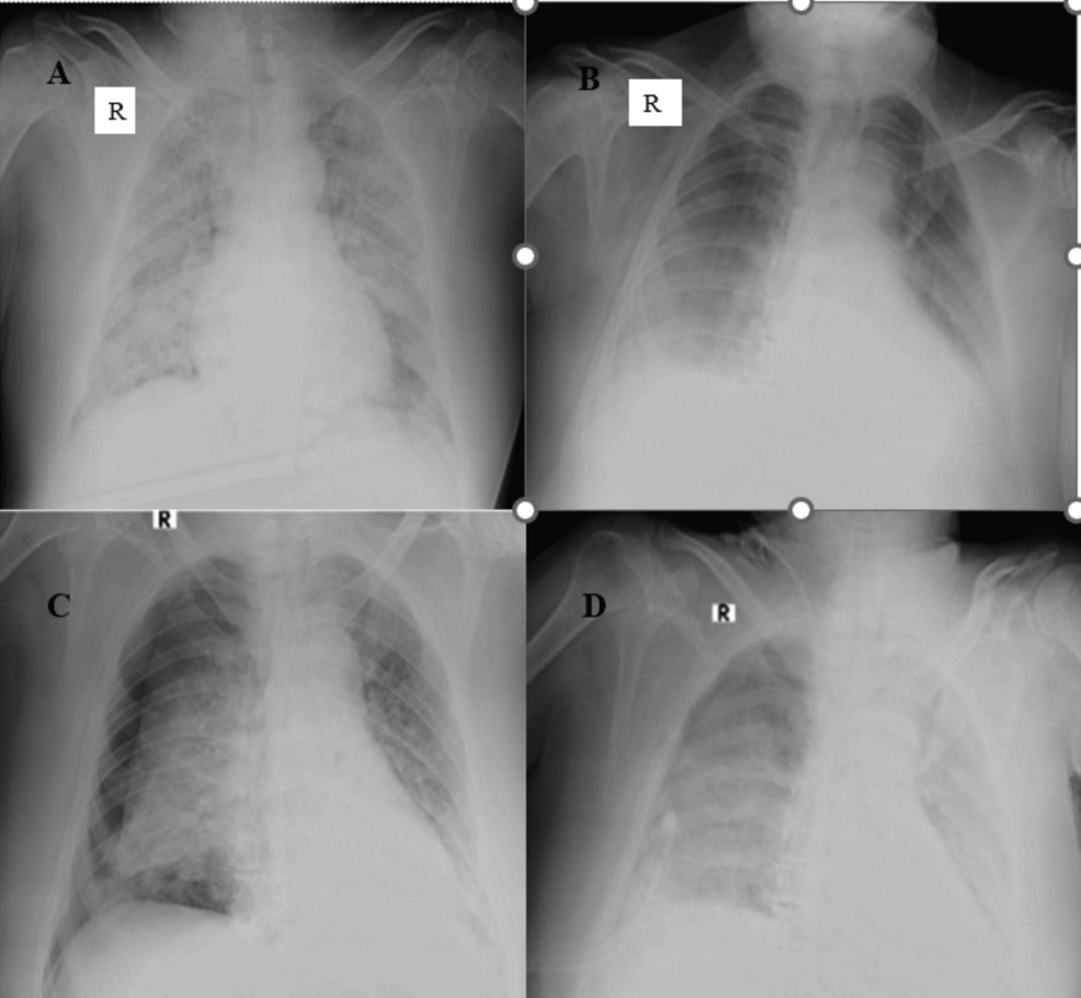 Figure-4A:-Chest-supine-radiograph-(anteroposterior-(AP)-view)-of-a-64-year-old-male-patient-showed-multiple-nodular-opacities,-ill-defined-ground-glass-opacities,-and-patchy-consolidation-areas-in-bilateral-lung-parenchyma-involving->-75%-of-parenchyma.-Radiographic-disease-severity-score-was-eight-(severe-grade).-Figure-4B:-Follow-up-chest-AP-supine-radiograph-of-the-same-patient-on-day-10-with-mechanical-ventilation-revealed-diffuse-areas-of-GGOs-in-the-bilateral-mid-and-lower-lung-zones-with-peripheral-and-basal-high-density-areas,-suggestive-of-consolidation.-The-lung-involvement-was-25%-to-50%-bilaterally,-and-score-four-represented-radiographic-improvement.-Figure-4C:-Follow-up-chest-AP-supine-radiograph-of-the-same-patient-on-day-12-showed-the-development-of-pneumothorax-on-the-right-side-(possibly-barotrauma-related).-Figure-4D:-Follow-up-chest-AP-supine-radiograph-of-the-same-patient-on-day-14-revealed-re-expansion-of-the-right-lung-with-minimal-residual-pneumothorax.-Diffuse-ground-glass-opacities-were-seen-in-the-entire-right-lung-field,-and-diffuse-areas-of-consolidation-were-seen-in-the-entire-left-lung-field.