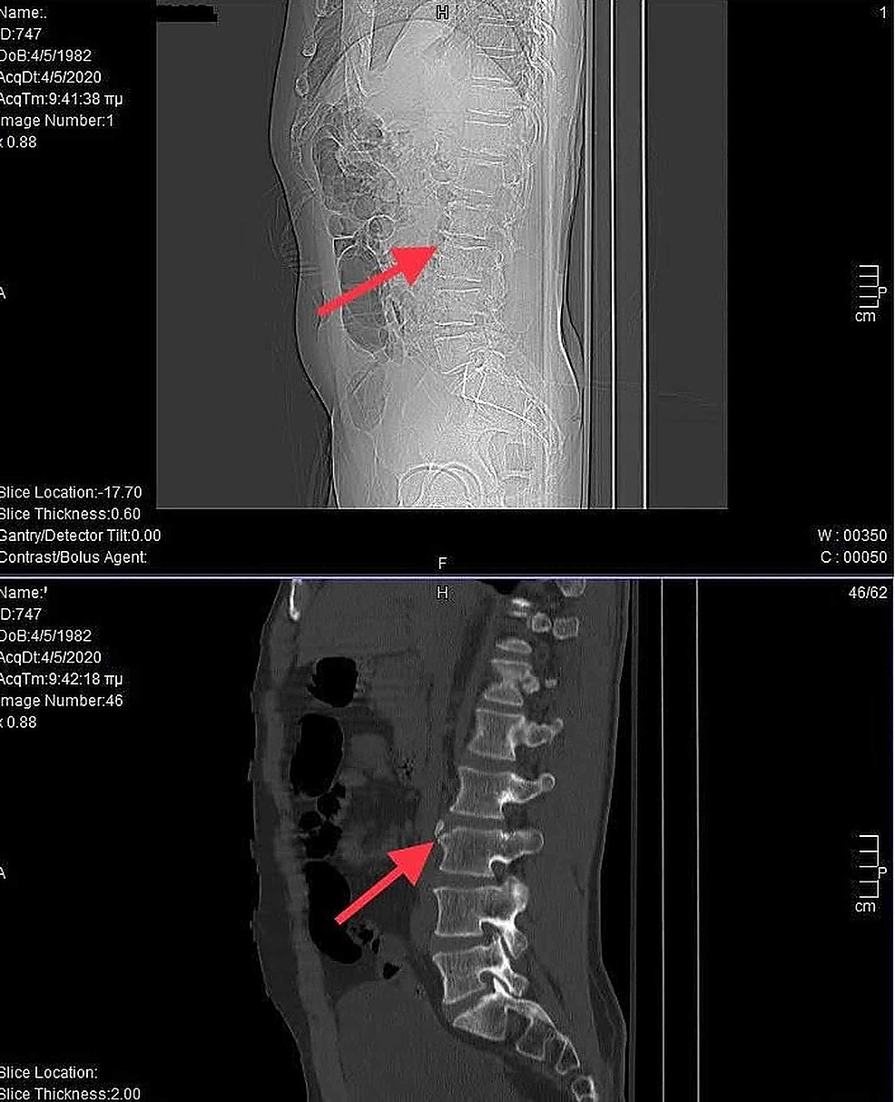 Cureus | Limbus Vertebrae as Incidental Finding in a Patient With Acute