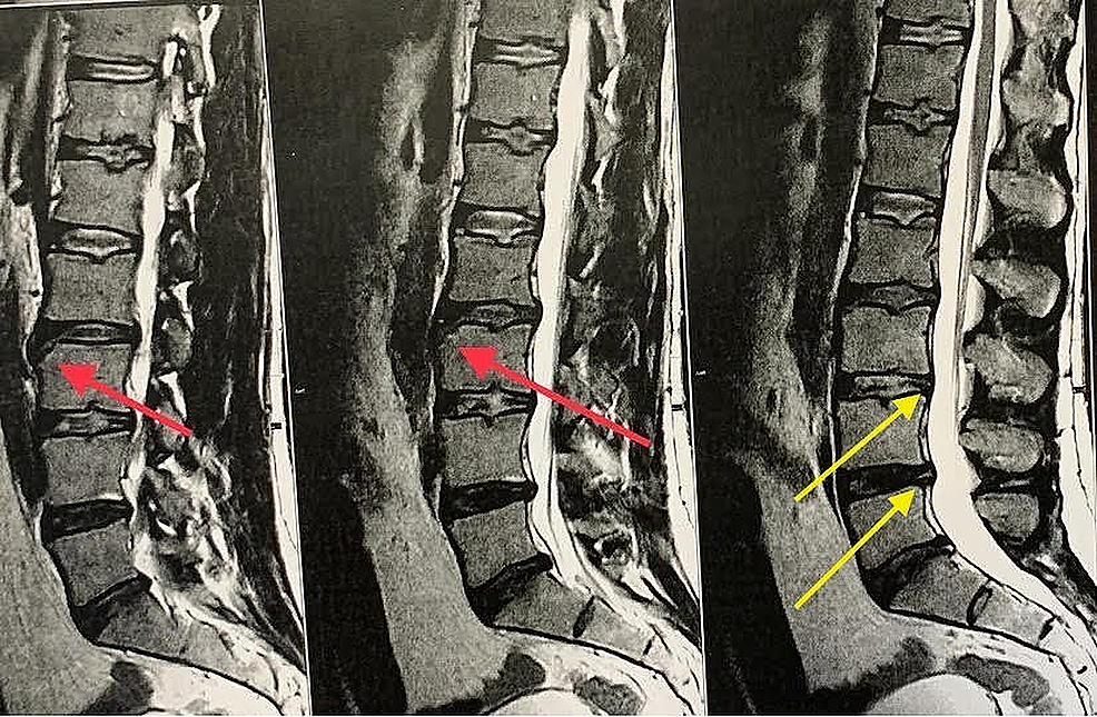 Cureus Limbus Vertebrae as Incidental Finding in a Patient With Acute