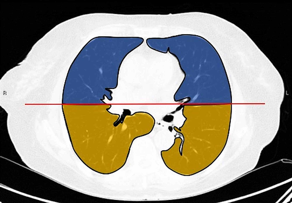 Division-of-lung-fields-in-the-axial-plane