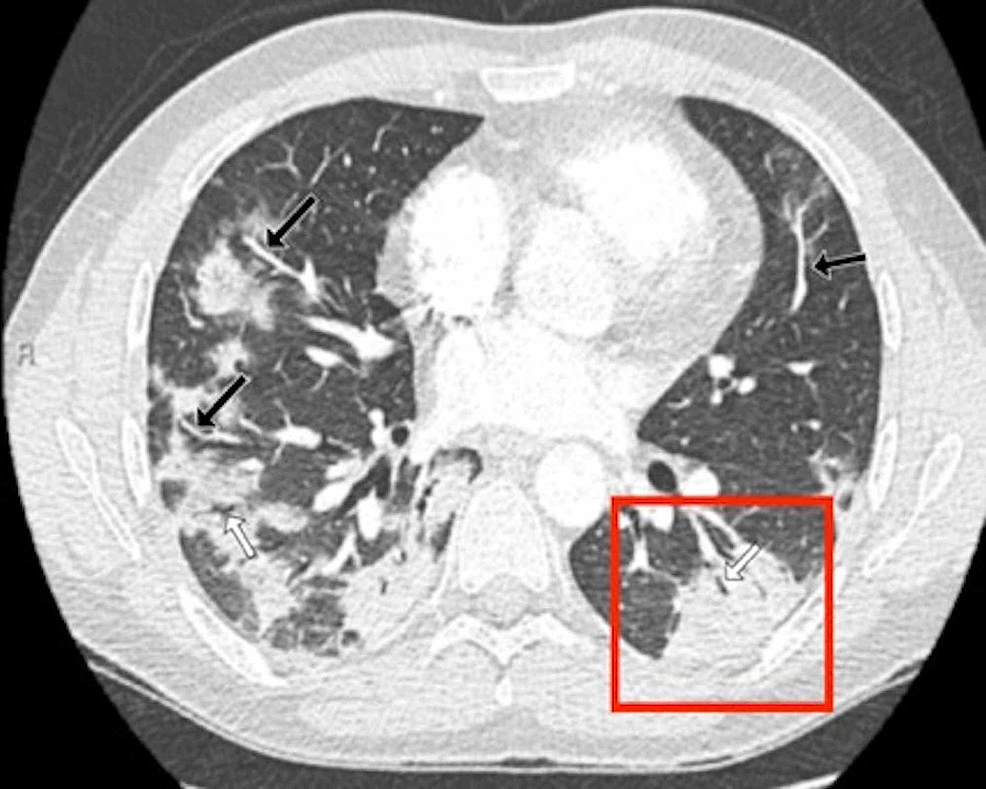 Chest-CT-findings-of-a-32-year-old-male-patient:-axial-CT-section-through-lung-bases