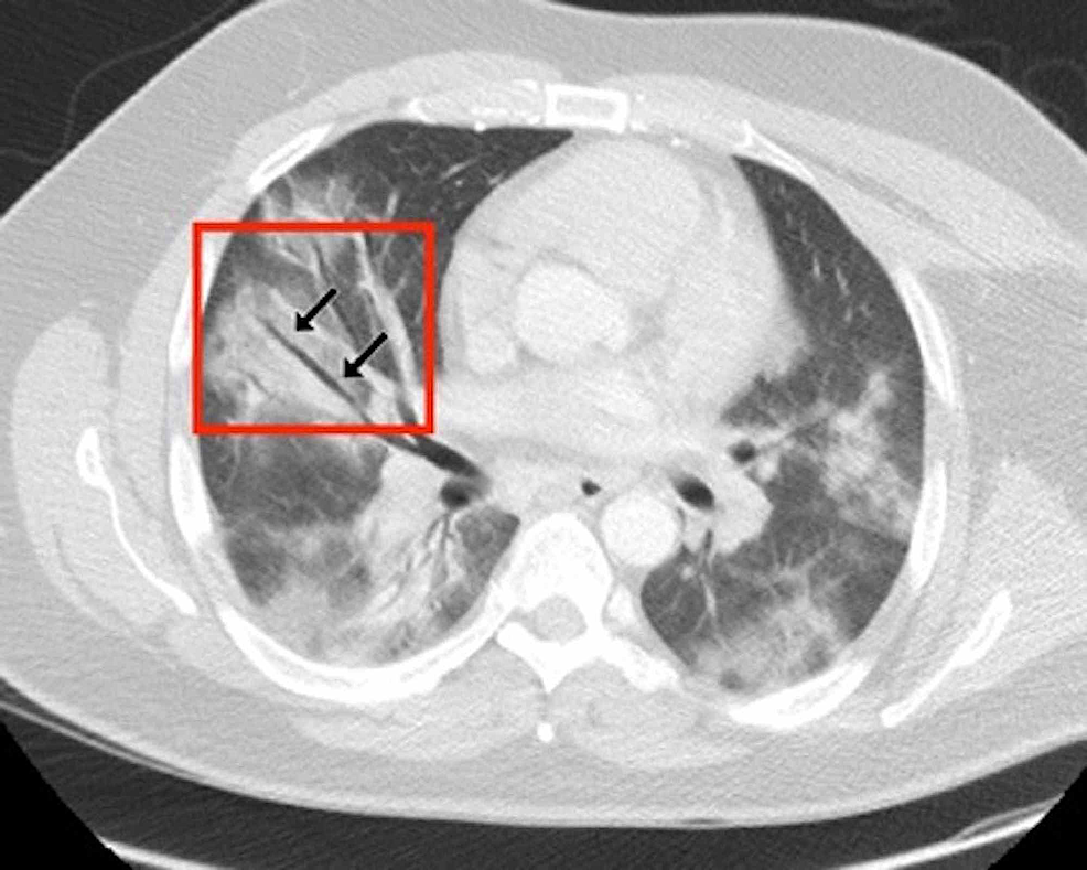 Axial-CT-through-lung-bases-of-a-male-patient-(lung-parenchymal-window-level-settings)