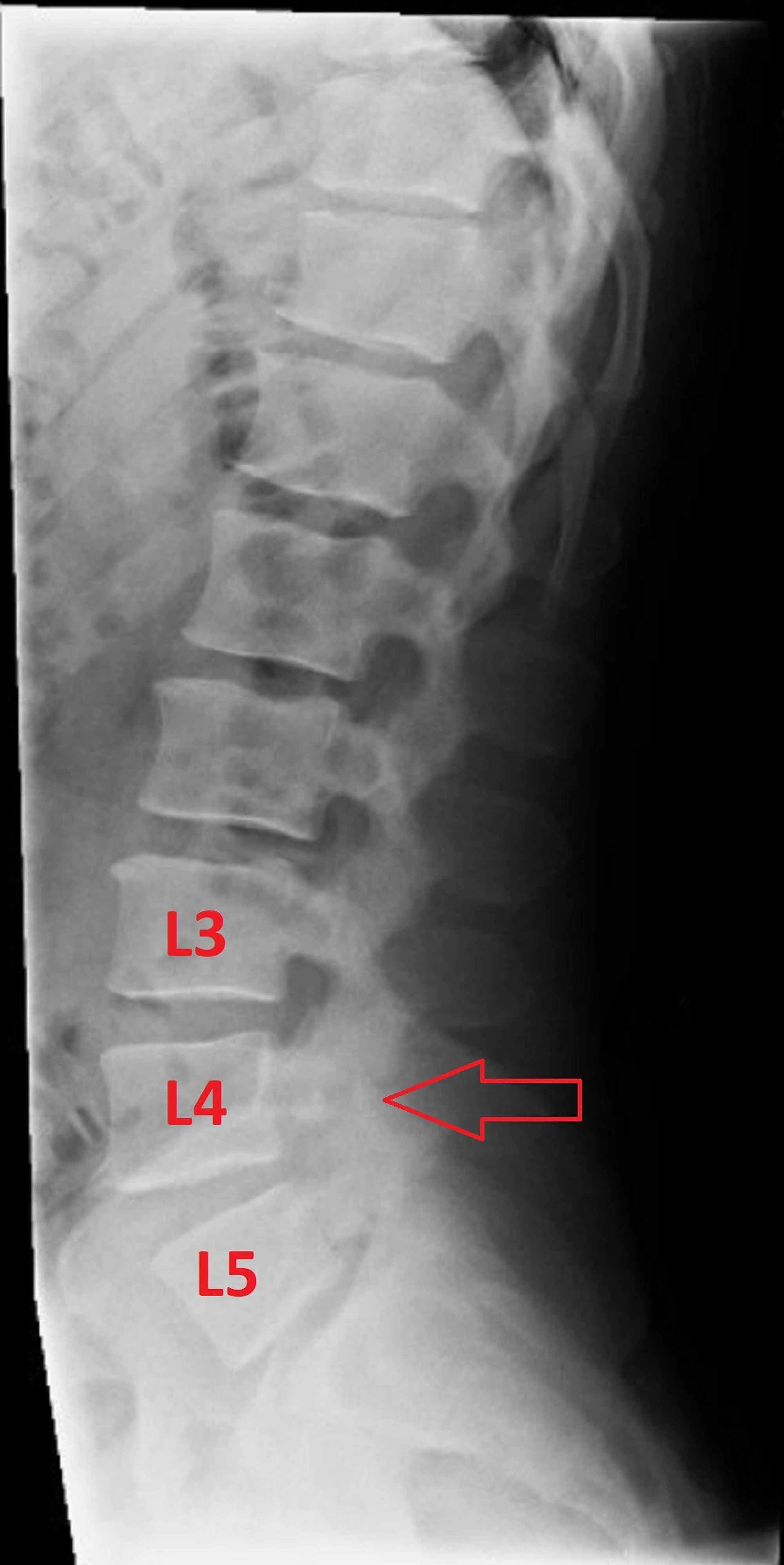 cureus-bilateral-acute-osteoporotic-lumbar-pedicle-fr-vrogue-co