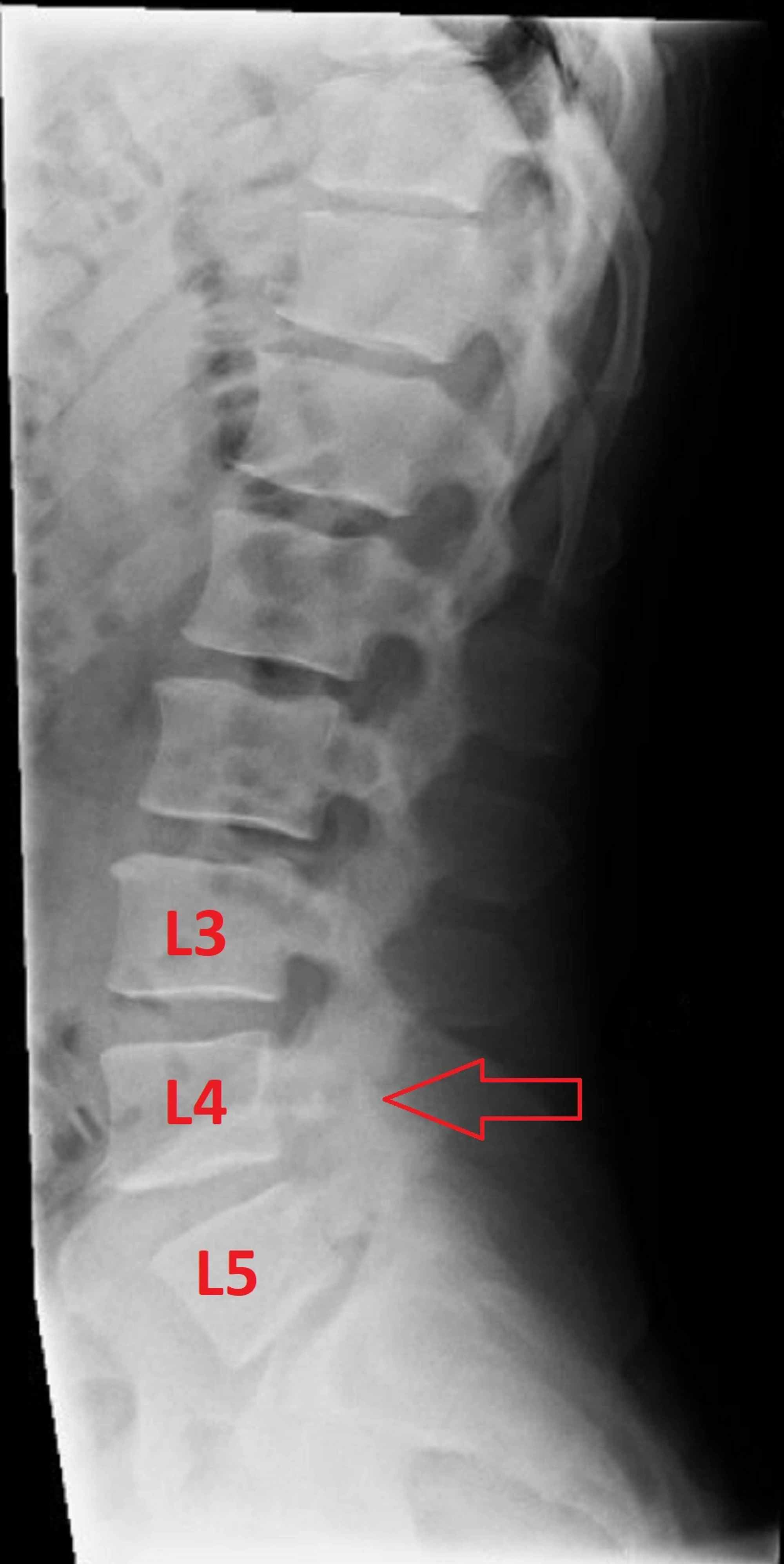 cervical spine torn ligament x ray