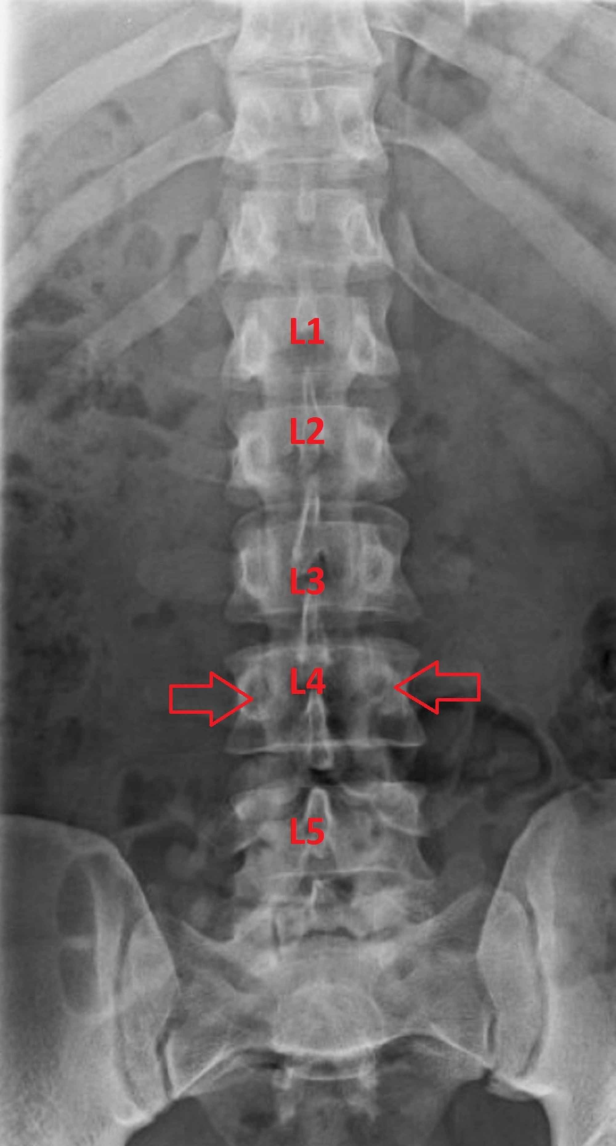 stress fracture in lower back